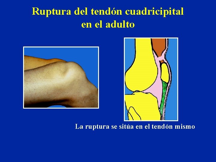 Ruptura del tendón cuadricipital en el adulto La ruptura se sitúa en el tendón