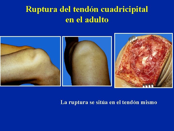 Ruptura del tendón cuadricipital en el adulto La ruptura se sitúa en el tendón