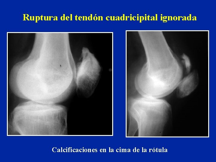 Ruptura del tendón cuadricipital ignorada Calcificaciones en la cima de la rótula 