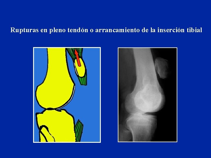 Rupturas en pleno tendón o arrancamiento de la inserción tibial 