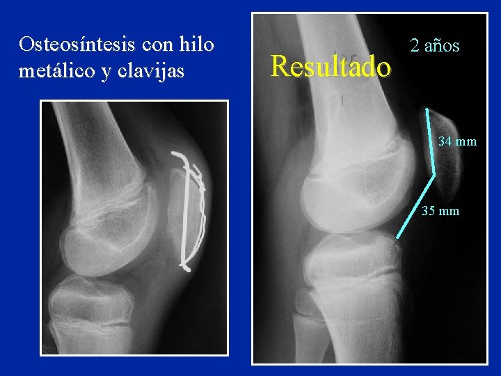 Osteosíntesis con hilo metálico y clavijas Resultado 2 años 34 mm 35 mm 