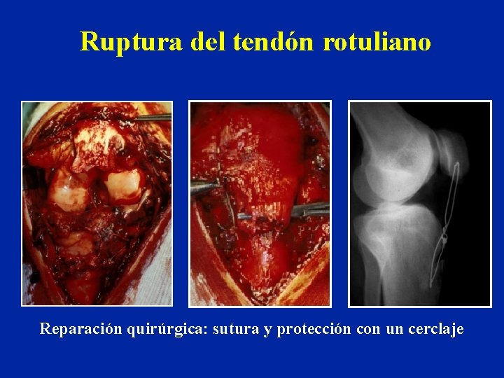 Ruptura del tendón rotuliano Reparación quirúrgica: sutura y protección con un cerclaje 