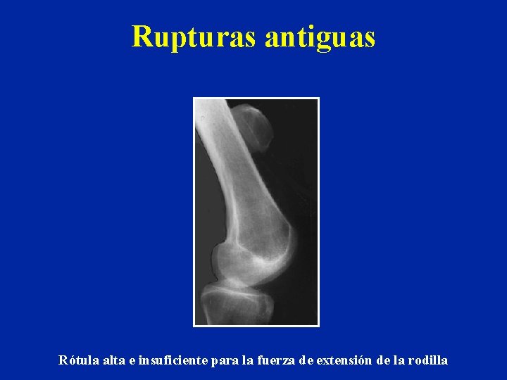 Rupturas antiguas Rótula alta e insuficiente para la fuerza de extensión de la rodilla