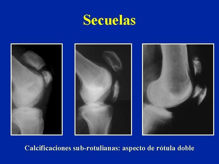 Secuelas Calcificaciones sub-rotulianas: aspecto de rótula doble 