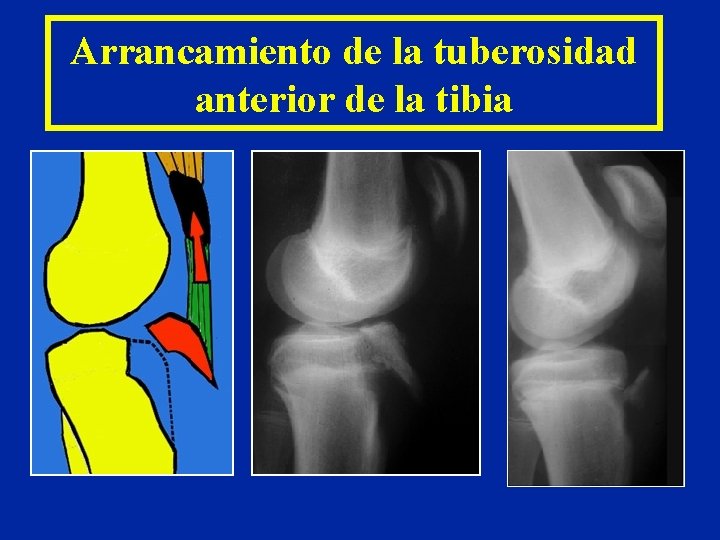 Arrancamiento de la tuberosidad anterior de la tibia 