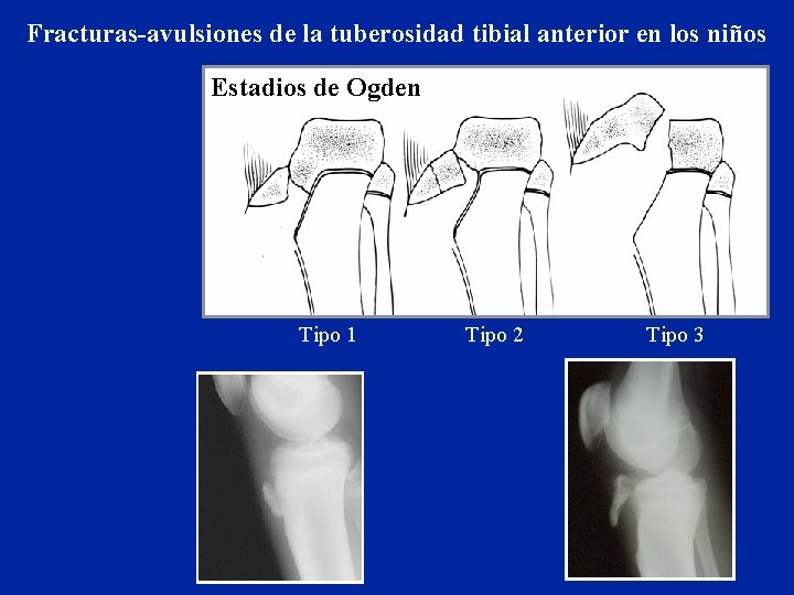 Fracturas-avulsiones de la tuberosidad tibial anterior en los niños Estadios de Ogden Tipo 1