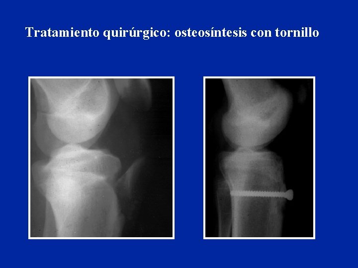 Tratamiento quirúrgico: osteosíntesis con tornillo 