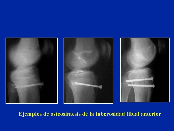 Ejemplos de osteosíntesis de la tuberosidad tibial anterior 