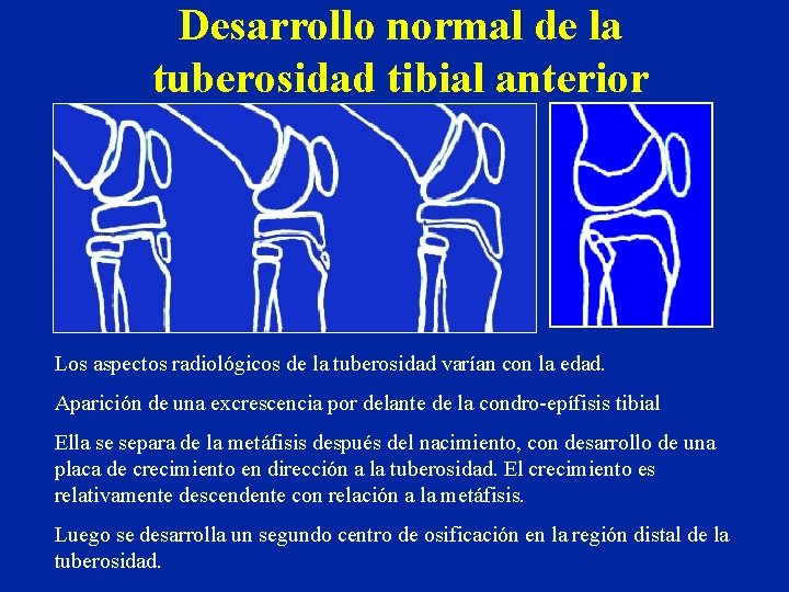 Desarrollo normal de la tuberosidad tibial anterior Los aspectos radiológicos de la tuberosidad varían