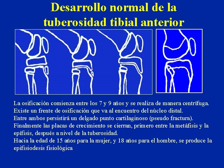 Desarrollo normal de la tuberosidad tibial anterior La osificación comienza entre los 7 y