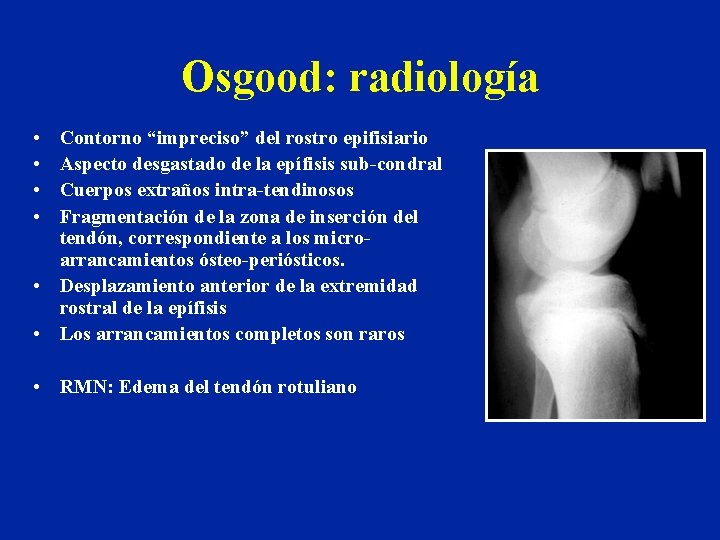 Osgood: radiología • • Contorno “impreciso” del rostro epifisiario Aspecto desgastado de la epífisis