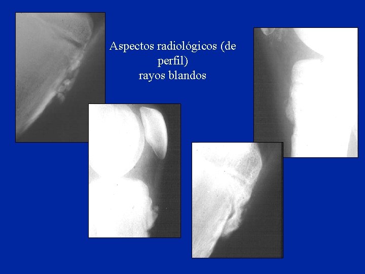 Aspectos radiológicos (de perfil) rayos blandos 