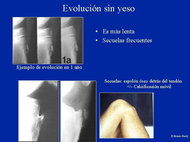 Evolución sin yeso • Es más lenta • Secuelas frecuentes Ejemplo de evolución en