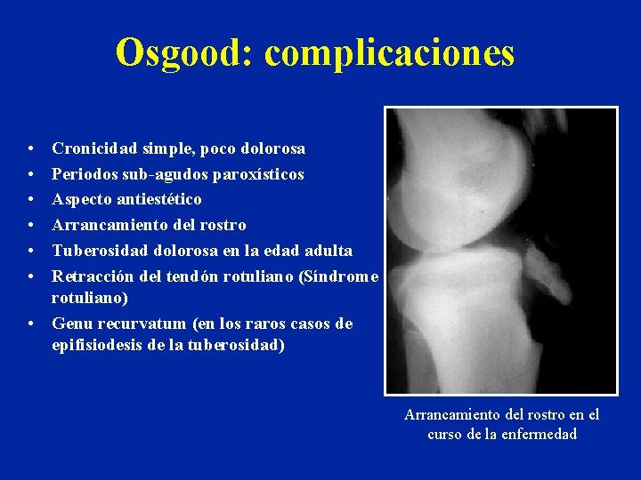 Osgood: complicaciones • • • Cronicidad simple, poco dolorosa Periodos sub-agudos paroxísticos Aspecto antiestético