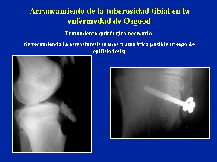 Arrancamiento de la tuberosidad tibial en la enfermedad de Osgood Tratamiento quirúrgico necesario: Se