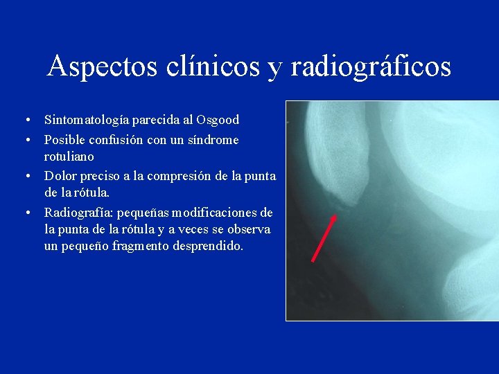 Aspectos clínicos y radiográficos • Sintomatología parecida al Osgood • Posible confusión con un