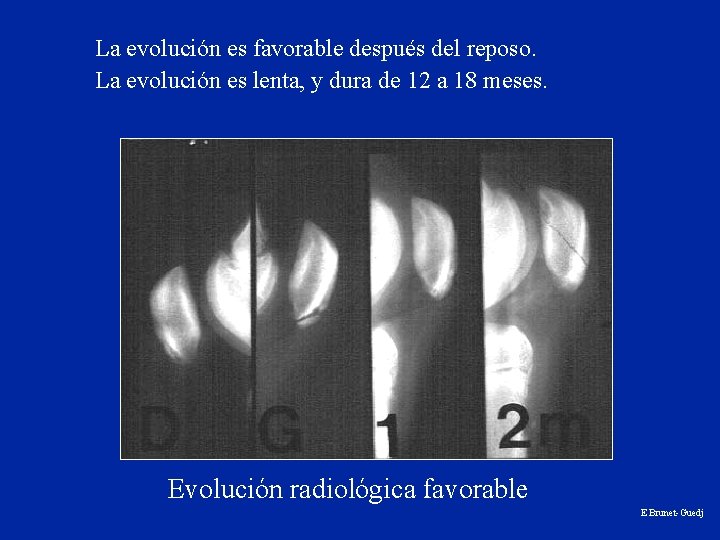 La evolución es favorable después del reposo. La evolución es lenta, y dura de