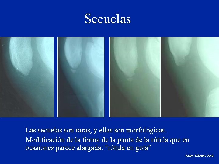 Secuelas Las secuelas son raras, y ellas son morfológicas. Modificación de la forma de