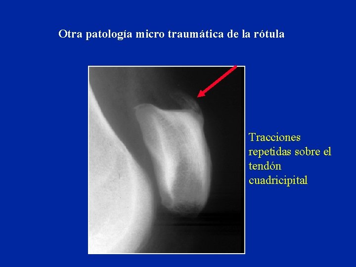 Otra patología micro traumática de la rótula Tracciones repetidas sobre el tendón cuadricipital 
