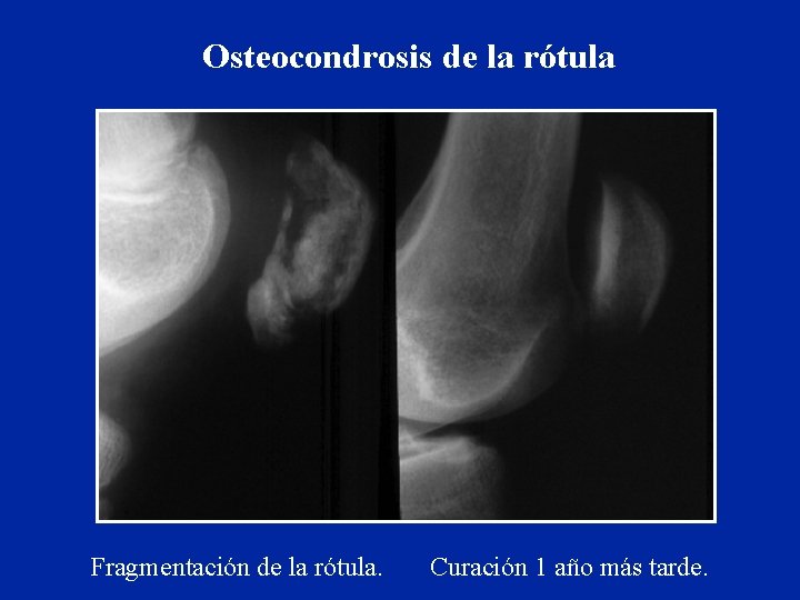 Osteocondrosis de la rótula Fragmentación de la rótula. Curación 1 año más tarde. 