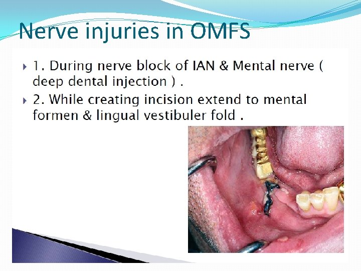 Nerve injuries in OMFS 