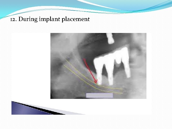 12. During implant placement 