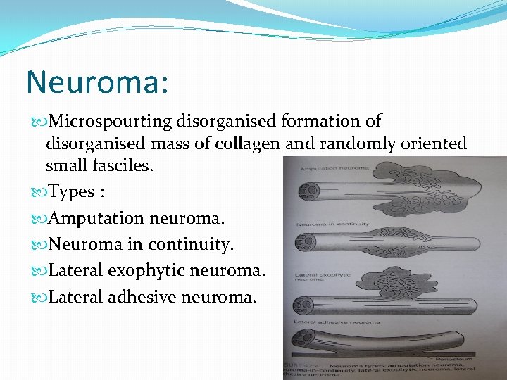 Neuroma: Microspourting disorganised formation of disorganised mass of collagen and randomly oriented small fasciles. Neuroma: Microspourting disorganised formation of disorganised mass of collagen and randomly oriented small fasciles.