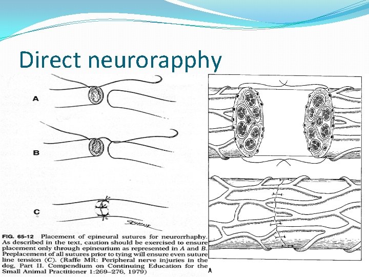 Direct neurorapphy Epineural sutures. No perineural sutures. 7 -0, 9 -0 nonabsorbable sutures. No