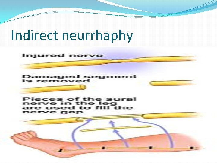 Indirect neurrhaphy Tension , nerve gap exists in direct neurrhaphy procedure. Grafting is considered. Indirect neurrhaphy Tension , nerve gap exists in direct neurrhaphy procedure. Grafting is considered.