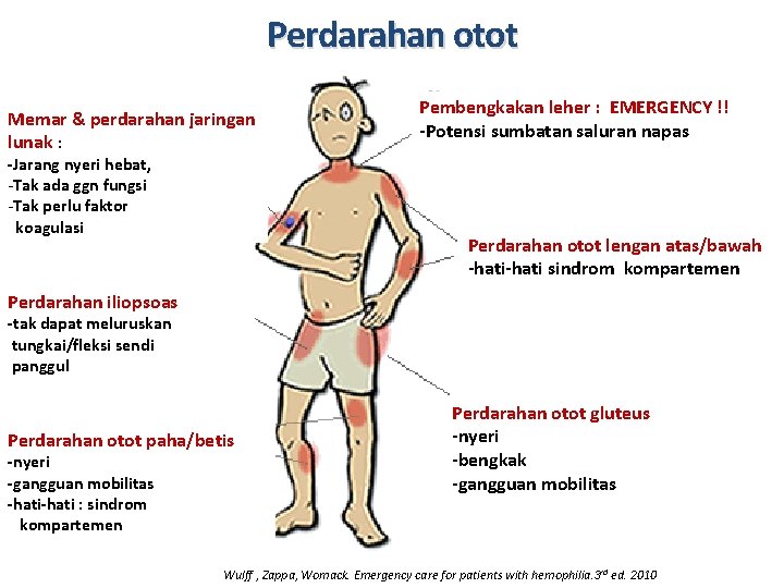 Perdarahan otot Memar & perdarahan jaringan lunak : -Jarang nyeri hebat, -Tak ada ggn