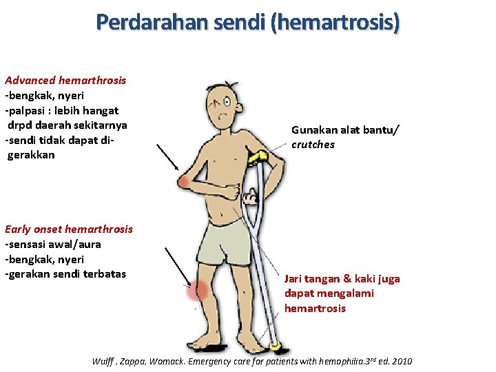 Perdarahan sendi (hemartrosis) Advanced hemarthrosis -bengkak, nyeri -palpasi : lebih hangat drpd daerah sekitarnya