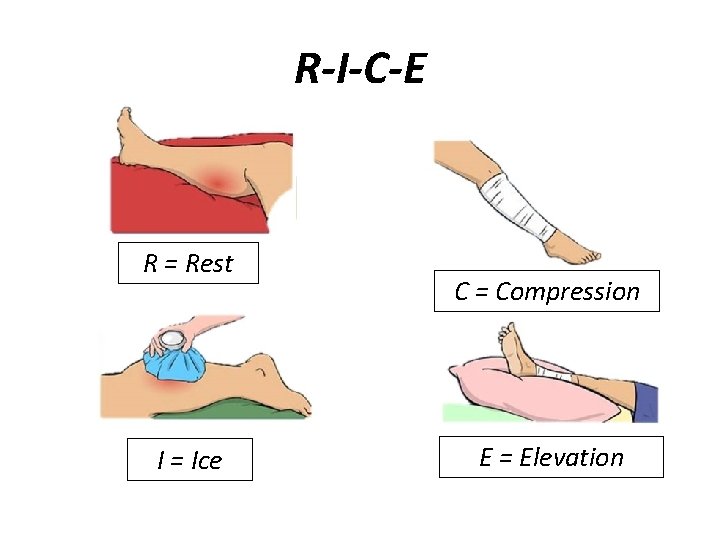 R-I-C-E R = Rest I = Ice C = Compression E = Elevation 