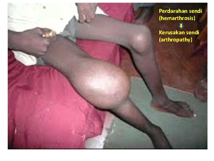 Perdarahan sendi (hemarthrosis) Kerusakan sendi (arthropathy) 