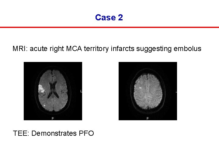 Case 2 MRI: acute right MCA territory infarcts suggesting embolus TEE: Demonstrates PFO 