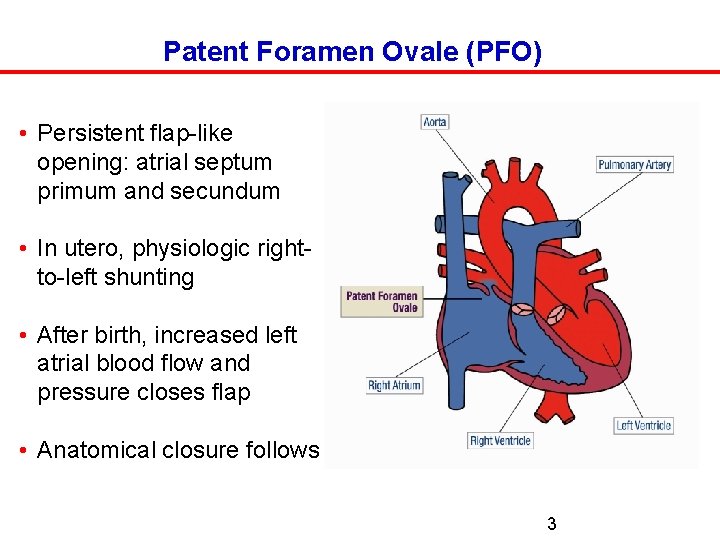 Patent Foramen Ovale (PFO) • Persistent flap-like opening: atrial septum primum and secundum •