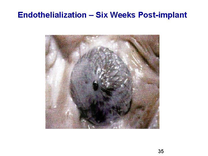 Endothelialization – Six Weeks Post-implant 35 