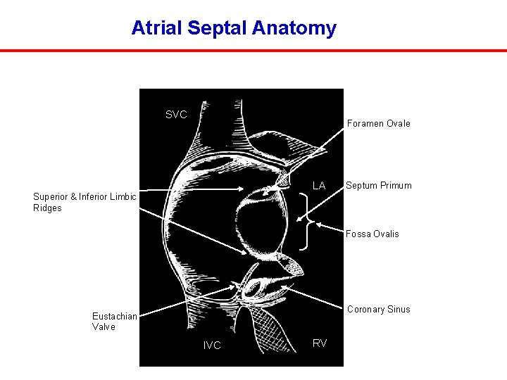 Atrial Septal Anatomy SVC Foramen Ovale LA Septum Primum Superior & Inferior Limbic Ridges