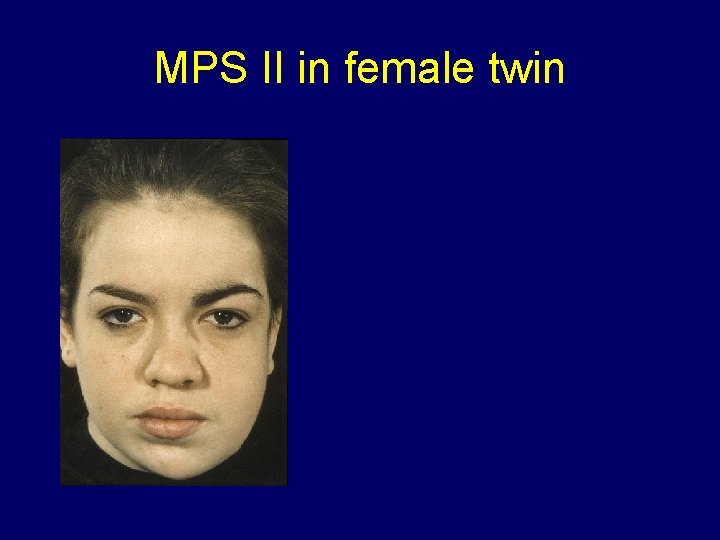 MPS II in female twin 