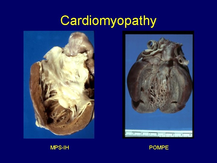 Cardiomyopathy MPS-IH POMPE 