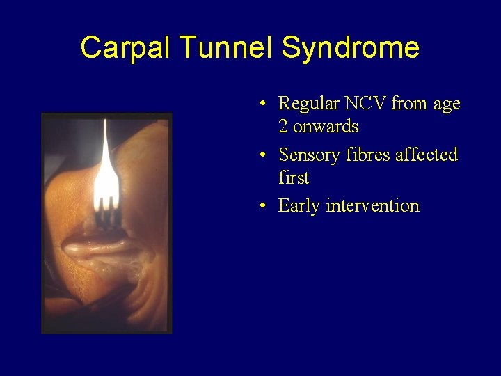 Carpal Tunnel Syndrome • Regular NCV from age 2 onwards • Sensory fibres affected