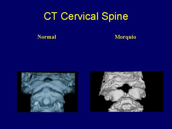 CT Cervical Spine Normal Morquio 