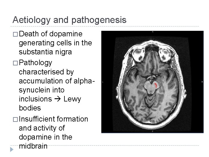 Aetiology and pathogenesis � Death of dopamine generating cells in the substantia nigra �