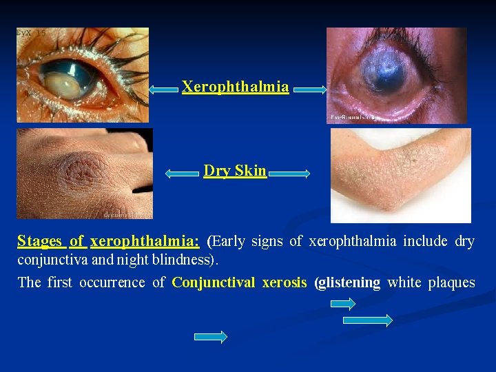 Xerophthalmia Dry Skin Stages of xerophthalmia: (Early signs of xerophthalmia include dry conjunctiva and