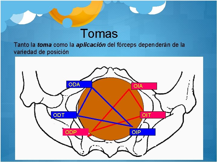 Tomas Tanto la toma como la aplicación del fórceps dependerán de la variedad de