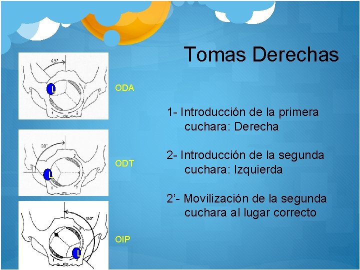 Tomas Derechas ODA L 1 - Introducción de la primera cuchara: Derecha ODT L