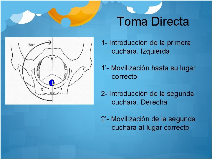 Toma Directa 1 - Introducción de la primera cuchara: Izquierda L 1’- Movilización hasta