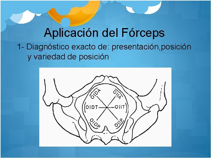 Aplicación del Fórceps 1 - Diagnóstico exacto de: presentación, posición y variedad de posición.