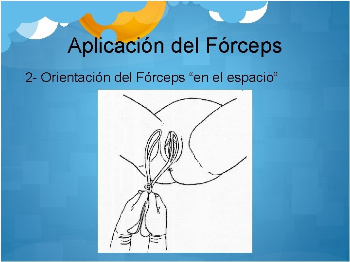 Aplicación del Fórceps 2 - Orientación del Fórceps “en el espacio” 