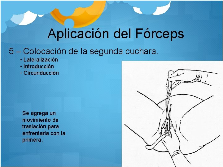 Aplicación del Fórceps 5 – Colocación de la segunda cuchara. • Lateralización • Introducción