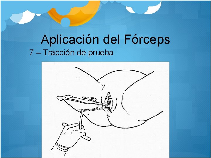 Aplicación del Fórceps 7 – Tracción de prueba 